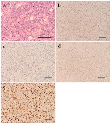 Case report: A rare case of triple negative breast cancer with development of acute pancreatitis due to dexamethasone during adjuvant chemotherapy